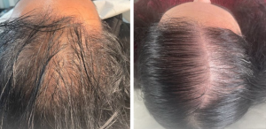 Ορός Μεσοθεραπείας & Derma Roller MyMed Revitalize Hair Κατά της Τριχόπτωσης 5x10mL