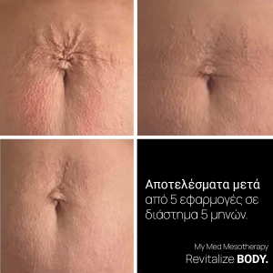 Ορός Μεσοθεραπείας & Derma Roller MyMed Revitalize Body Για Σύσφιξη & Ραγάδες 5x5mL