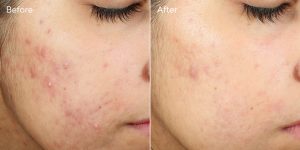 Θεραπεία Κατά Των Ουλών Ακμής Invisiscar™ Resurfacing Treatment - Jumbo Size 30mL